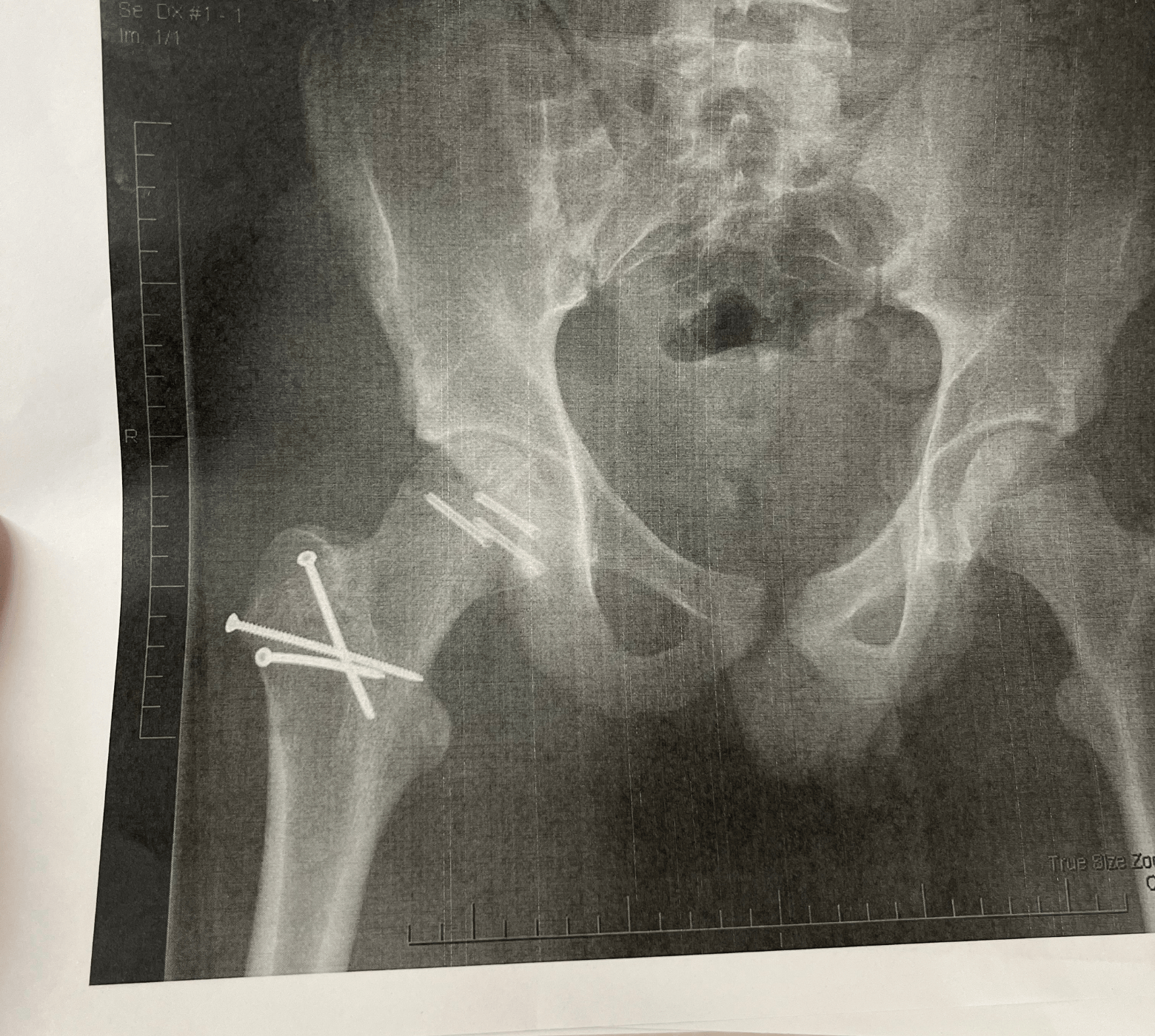 Riley's hip xray